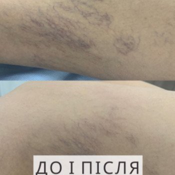 Фото из портфолио специалиста Юлия Моргун (флеболог, Хмельницкий)