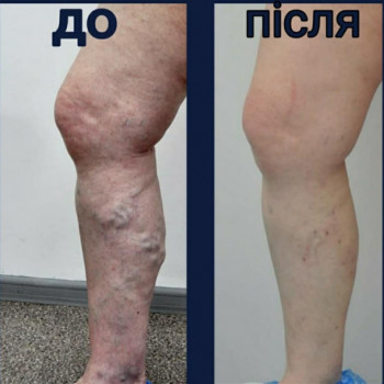 Фото из портфолио специалиста Валерий Гринчук (флеболог, Хмельницкий)