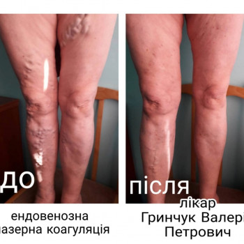 Фото из портфолио специалиста Валерий Гринчук (флеболог, Хмельницкий)