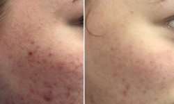 Карбоновый пиллинг Майстер перманентного макіяжу Ольга Черкаси