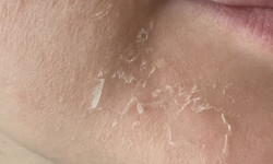 Поверхностный пилинг Врач-косметолог Яна Харьков