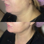 Конутрна пластика овалу обличчя Дерматолог косметолог Нелли Київ