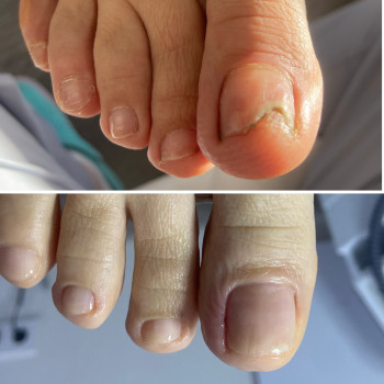 Деформація нігттьової пластини