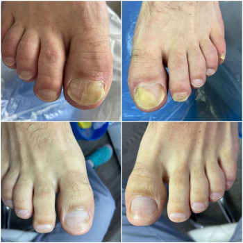 Грибкове ураження нігтів, оніхомікоз