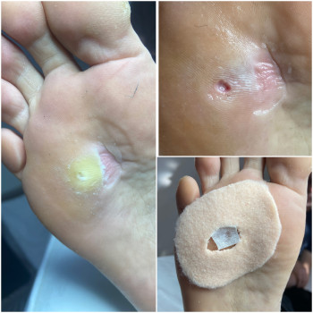 Стрижневий мозоль