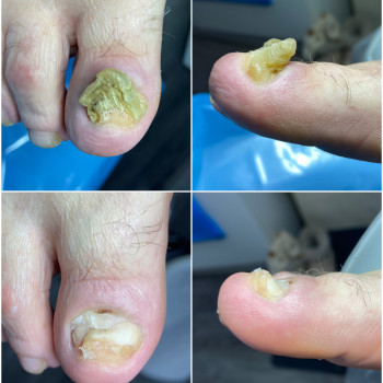 Деформація нігтів , онихіхогрифоз