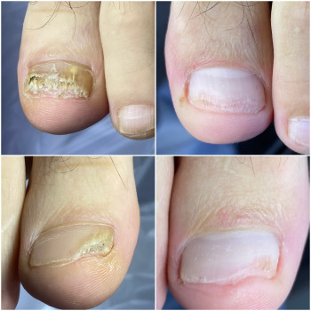 Оніхомікоз , результат роботи з грибковим ураженням