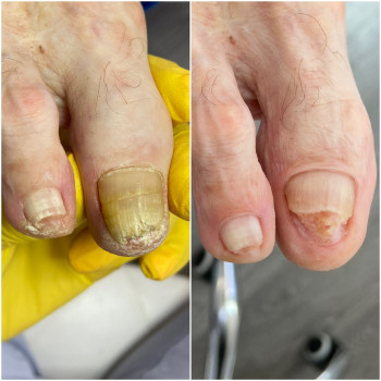 Зачистка нігтів