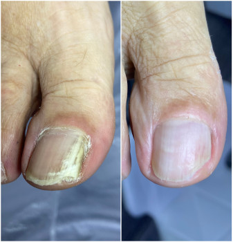 Результати роботи з грибковим ураженням нігтів