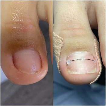 Робота з формою нігтів , обробка колонігтьових мозолів