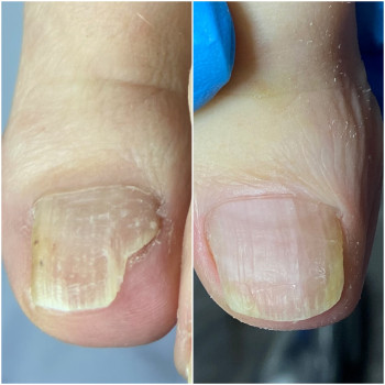 Деформація нігтя, результат роботи за формою