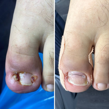 Оніхокриптоз, робота з врослий нігтем