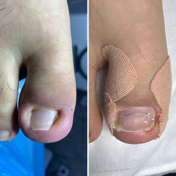 Оніхокриптоз, робота з врослий нігтем