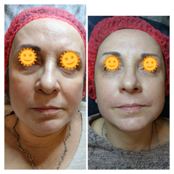 Пролонгована біоревіталізація препаратом RRS HA Long Lasting+PDRN Ami Eyes
 
 
 
 
 