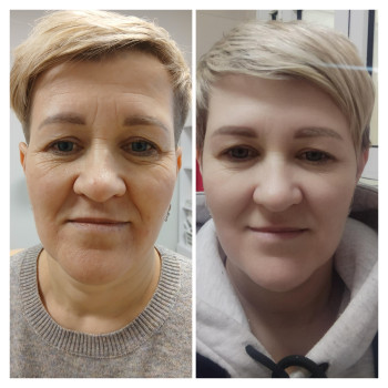 Результат через 2 тижні
 
 
 