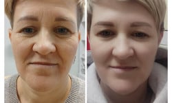 Ліфтинг Монако Косметолог Ірина Львів