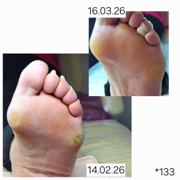 Зачистка 
Подологічний препарат
Устілка
Багато зусиль не потребує,але результат ви бачите. 
Це в...