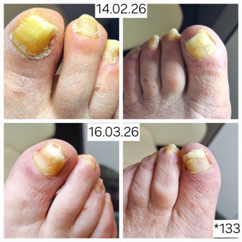 Дії: зачистка
Гігієна
Устілка
І це також може призвести до жити"без болю"через потовщені нігті,ес...