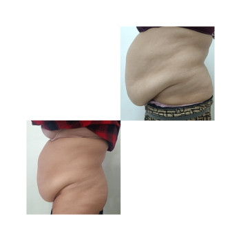 Біопатид, на фото результат однієї процедури ( перша) через тиждень