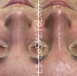 Комбінована чистка обличчя Косметолог-ін'єкціоніст Liubov Київ