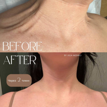 биоревитализация, мезотерапия, ботокс в шею, бланшинг шеи