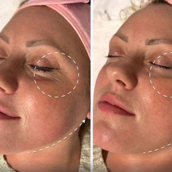 Ботокс лица вокруг глаз лифтинг мезотерапіяобличчя мезотерапія навколо очей, фото - врач-косметолог Юлія Мешко