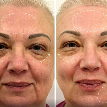 ботокс навколо очей, апаратна косметологія обличчя, підтяжка обличчя, ліфтинг обличчя, контурна пластика обличчя