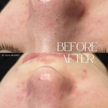 чистка лица, атравматичная чистка, ультразвуковачисткаобличчя, комбинированная чистка лица, косметологія обличчя