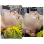 Свежая кожа уже после 1 процедуры пилинга Косметолог-естетист Людмила Харків