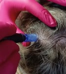 Акція на процедуру для стимуляції росту волосся Косметолог  Хмельницький