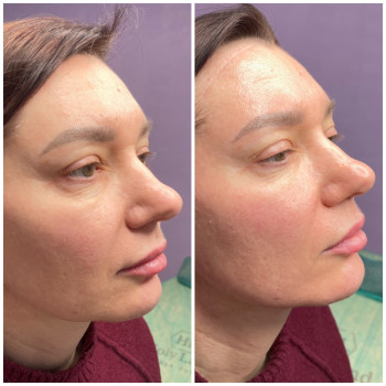 Fotona омолодження, фото - косметолог Ольга Мельник