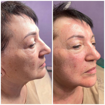 Лазерне омолодження на апараті Fotona, фото - косметолог Ольга Мельник