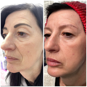 Лазерне омолодження + полінуклеотиди, фото - косметолог Ольга Мельник