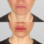 Контурна пластика губ Дерматолог косметолог Нелли Київ