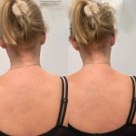 Ботулінотерапія TrapTox Дерматолог косметолог Нелли Київ