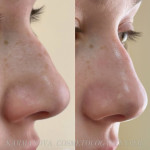 Комбінована чистка обличчя Дерматолог косметолог Нелли Киев