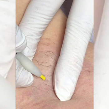 Процес електроепіляції у студії Майї Філатової.