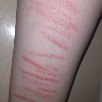 Видалення шрамів