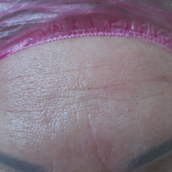 Омоложення