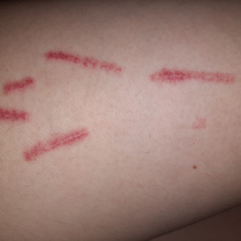 Видалення шрамів