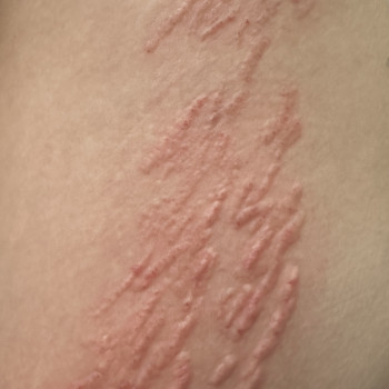 Видалення розтяжок