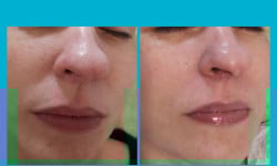 Exosome lift-Экзосомы(микронидллинг) Косметолог-естетист Ирина Валерьевна Одеса