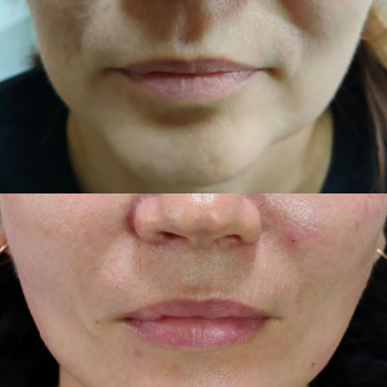 Фото из портфолио косметолога Анастасия Колесник (Харьков)