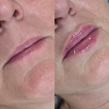 Фото из портфолио косметолога Анастасия Колесник (Харьков)