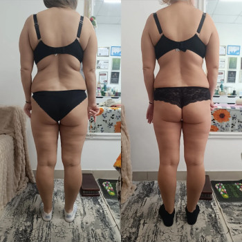 Антицелюлітні масажі