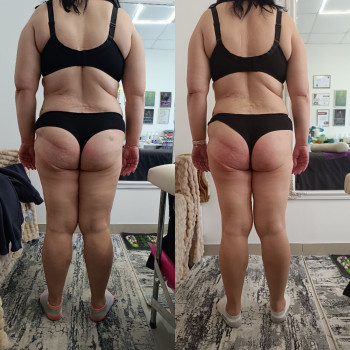 Антицелюлітні масажі