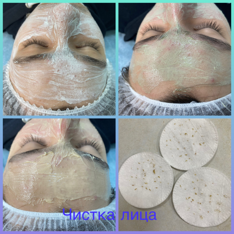 Чистка лица для подростков, фото - Майстер з пірсингу Тетяна Ананьєва