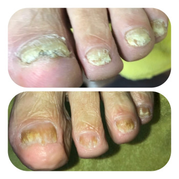 Зачистка онихомикоза (грибок), фото - подолог Ірина Абраменко