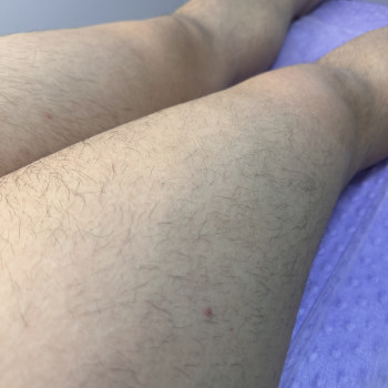 До, фото - майстер депіляції Анастасия Бондарева