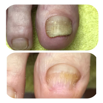 Фото из портфолио специалиста Ірина Абраменко (подолог, Кременчуг)